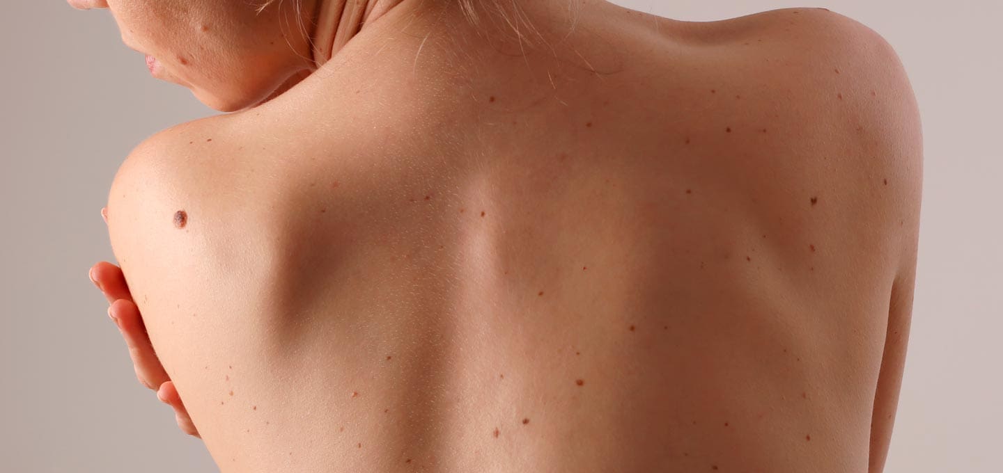 AA Plastic Surgery - Electrosurgery & Curettage