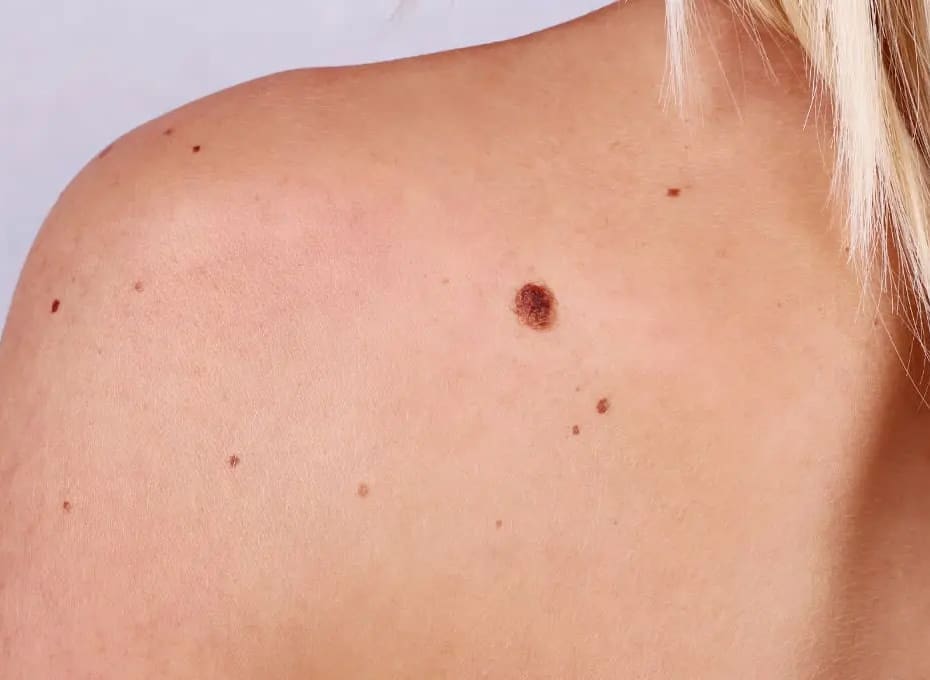 Ahid-Abood - Plastic Surgery Reconstruction After Skin Cancer Removal