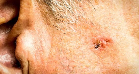 Ahid Abood - Basal Cell Carcinoma