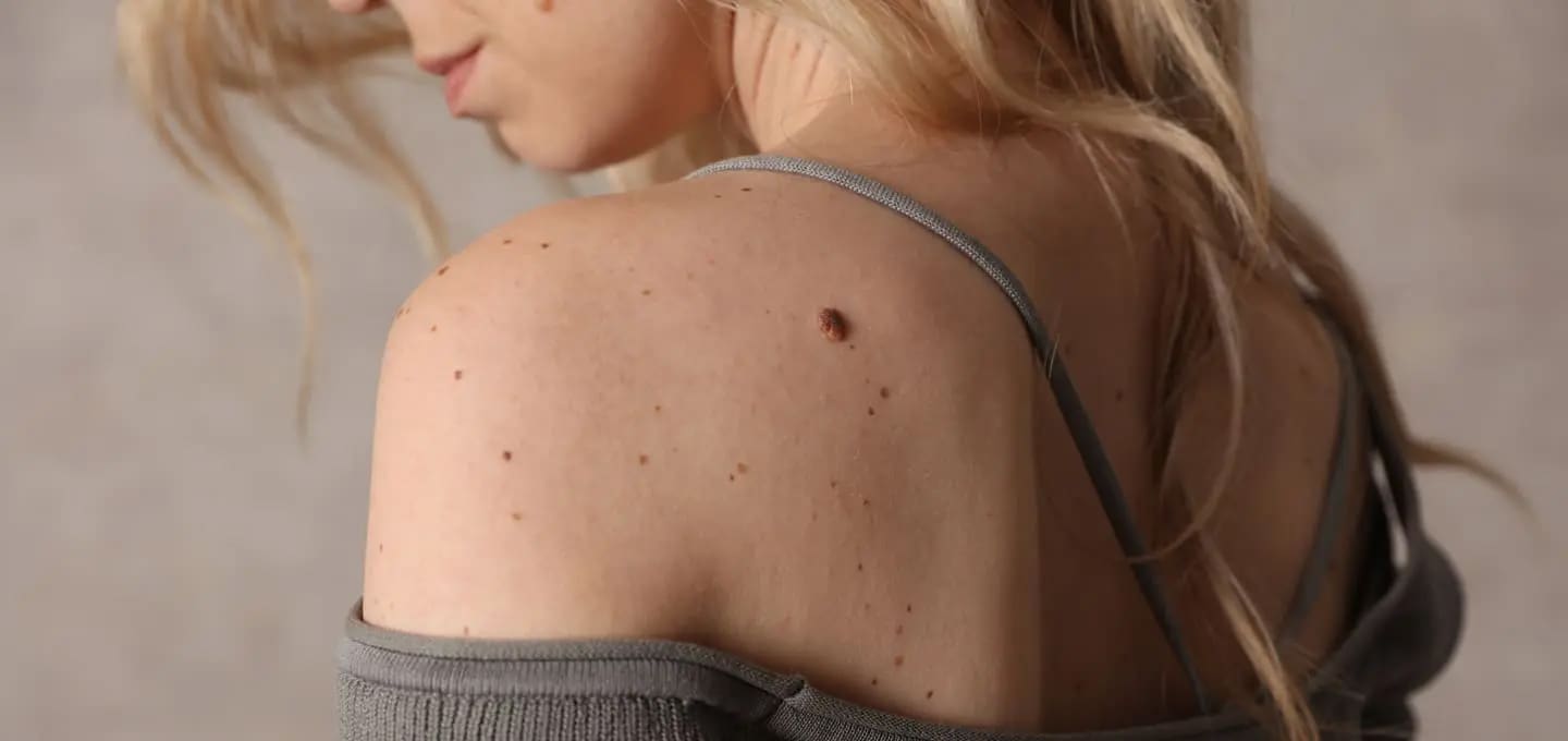 Ahid Abood - Skin Tags