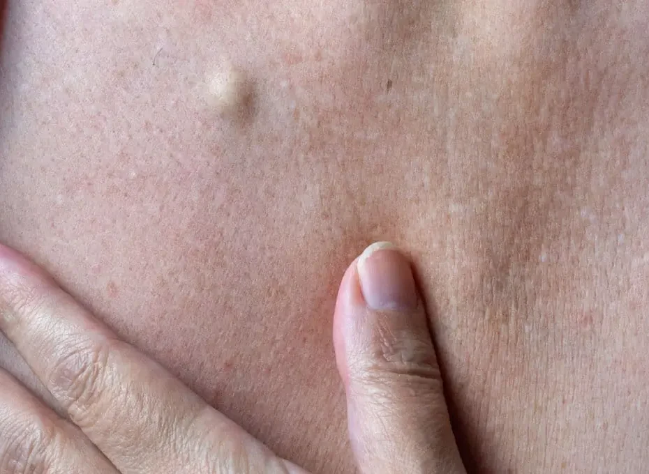 Skin cyst in the chest area