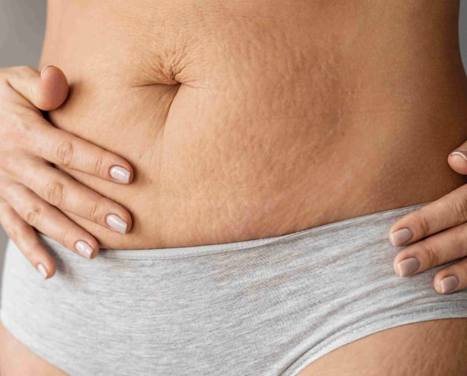 A woman showing her stomach stretch marks after pregnancy